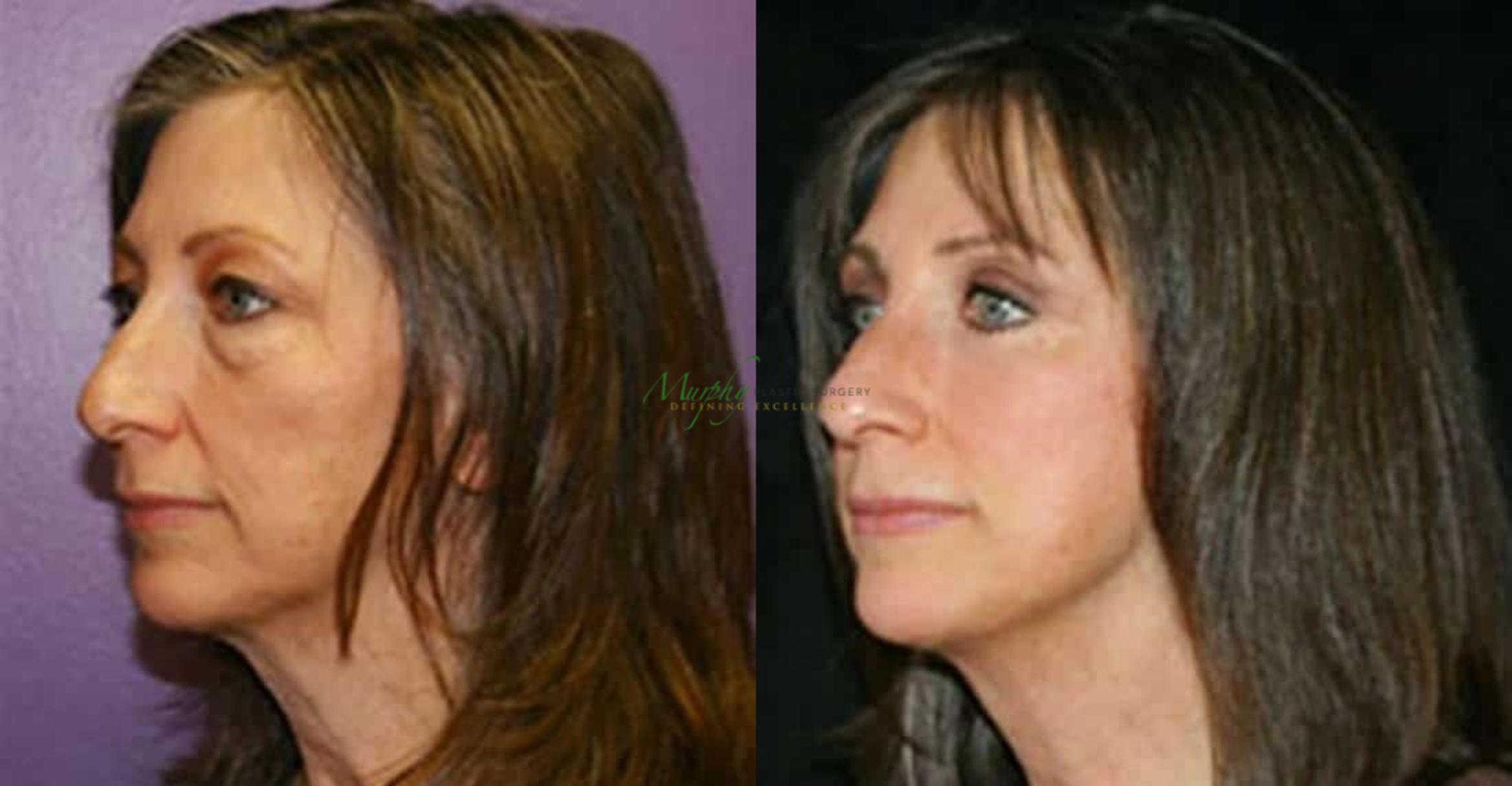 Before & After Mini Facelift Case 2 Left Oblique View in Denver, Colorado