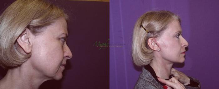 Before & After Mini Facelift Case 3 Right Side View in Denver, Colorado