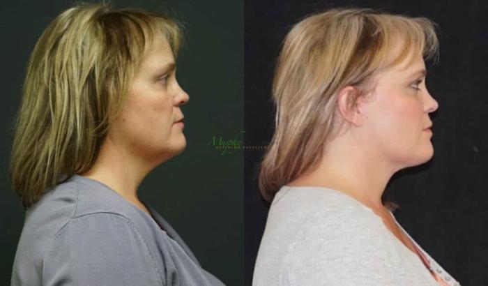 Before & After Mini Facelift Case 4 Right Side View in Denver, Colorado