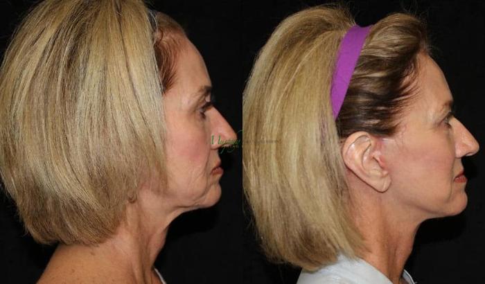 Before & After Mini Facelift Case 5 Right Side View in Denver, Colorado