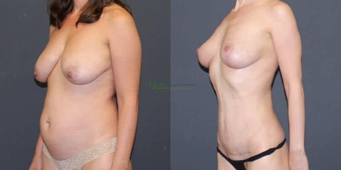 Before & After Mommy Makeover Case 36 Left Oblique View in Denver, Colorado