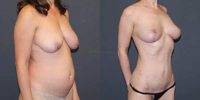 Before & After Mommy Makeover Case 36 Right Oblique View in Denver, Colorado