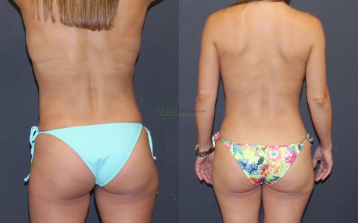 Before & After Mommy Makeover Case 38 Back View in Denver, Colorado