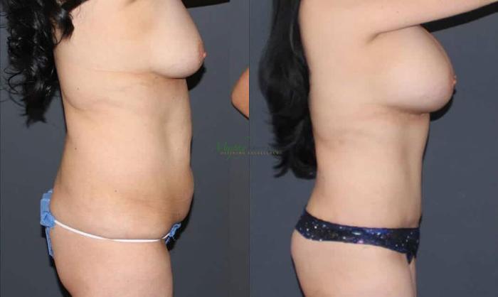 Before & After Mommy Makeover Case 39 Right Side View in Denver, Colorado