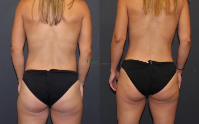 Before & After Mommy Makeover Case 40 Back View in Denver, Colorado