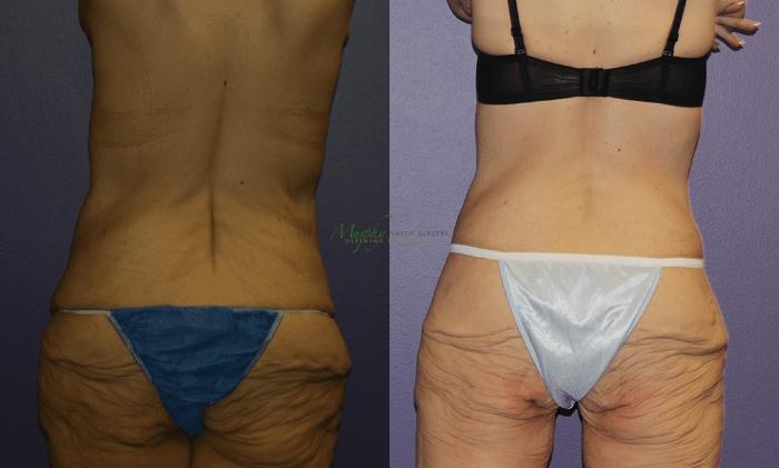Before & After Mommy Makeover Case 41 Back View in Denver, Colorado