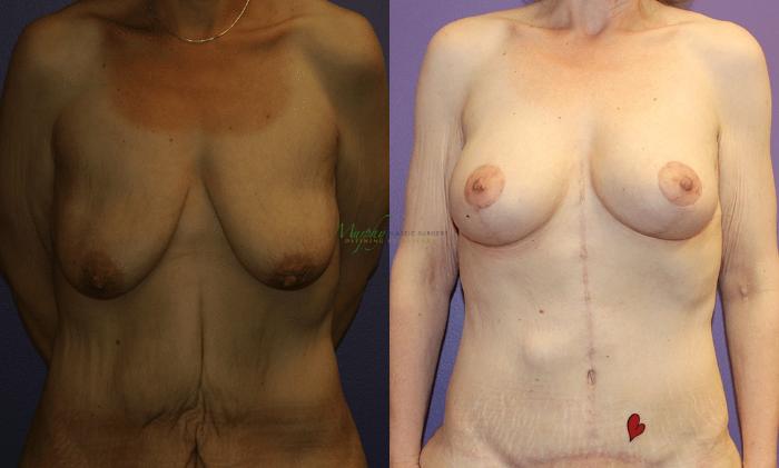 Before & After Mommy Makeover Case 41 Front Breasts View in Denver, Colorado