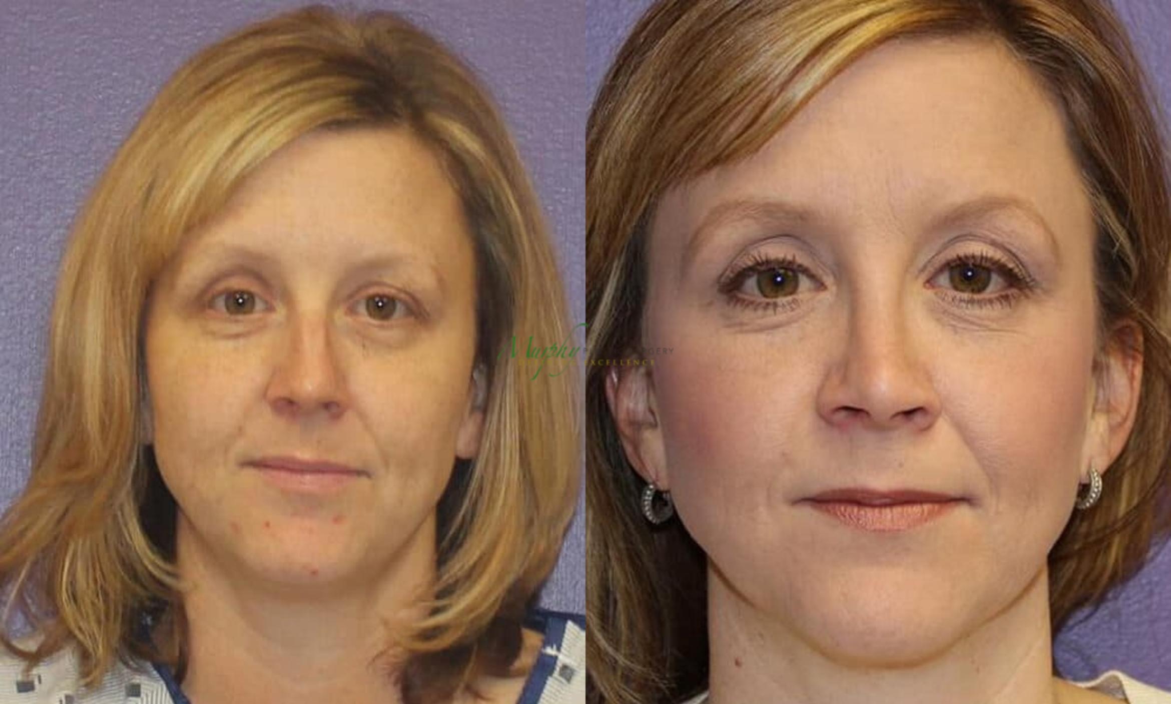 Before & After Rhinoplasty Case 26 Front View in Denver, Colorado