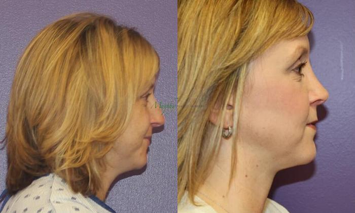Before & After Rhinoplasty Case 26 Right Side View in Denver, Colorado