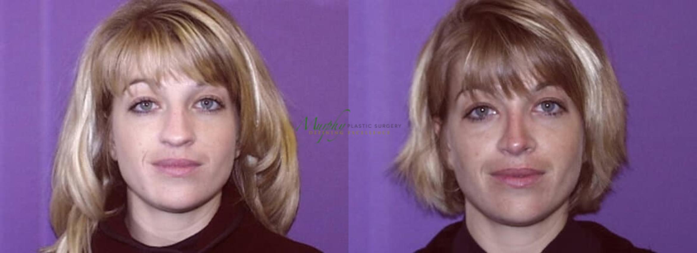Before & After Rhinoplasty Case 27 Front View in Denver, Colorado