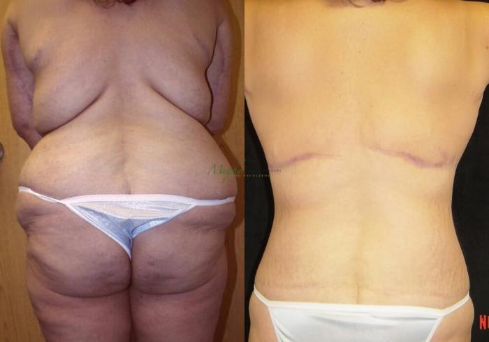 Before & After Weight Loss / Bariatric Case 35 Back View in Denver, Colorado