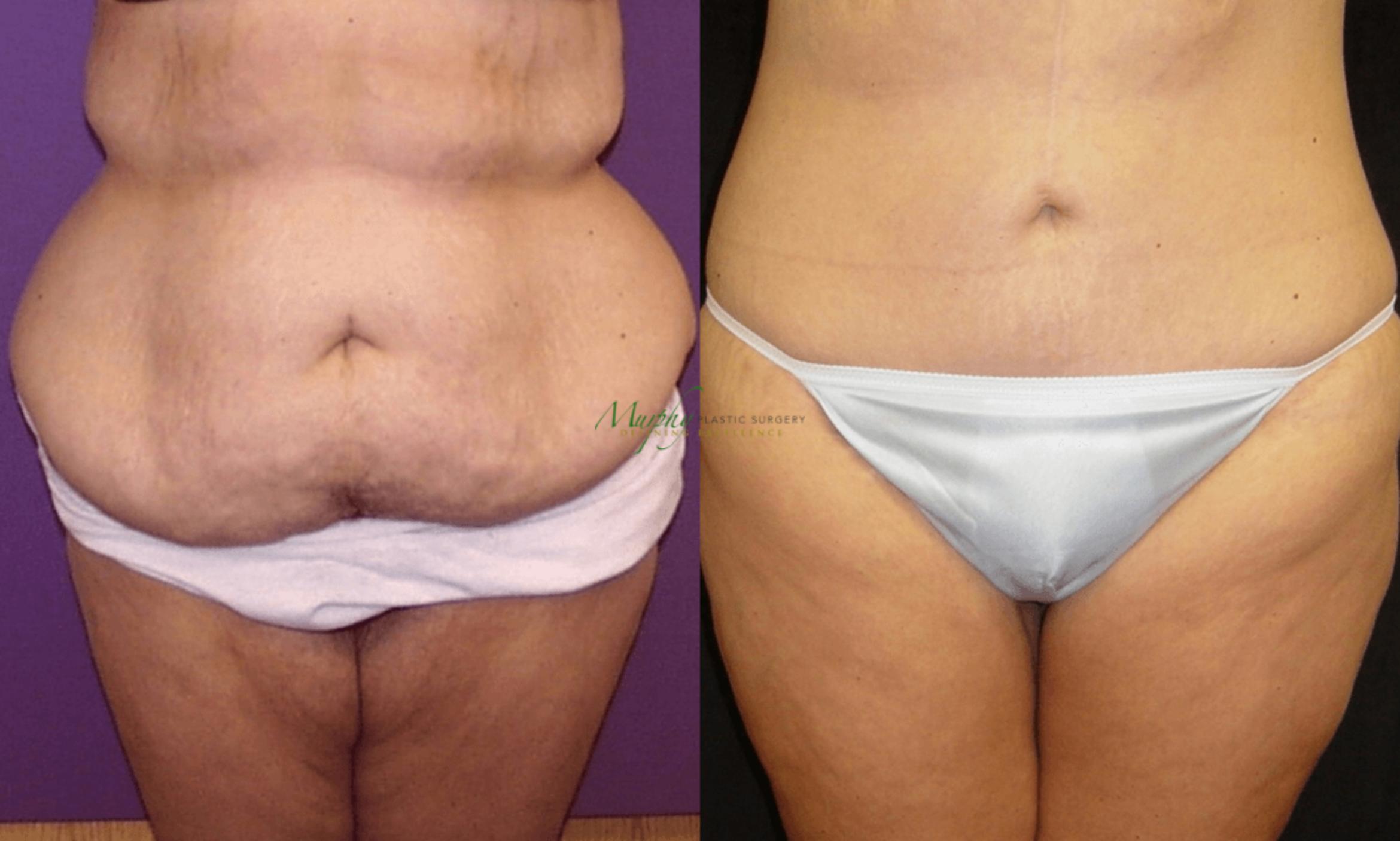 Before & After Weight Loss / Bariatric Case 35 Front View in Denver, Colorado